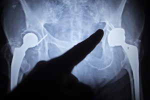 How To Relieve Pain After Hip Replacement Surgery?