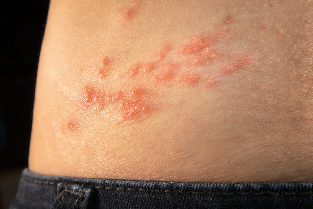 How to Manage Shingles Pain